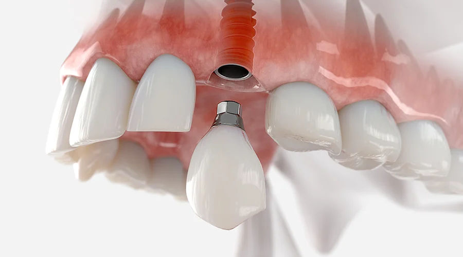 Dental implant restoration treatment