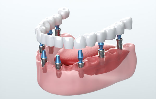Dental implant treatment