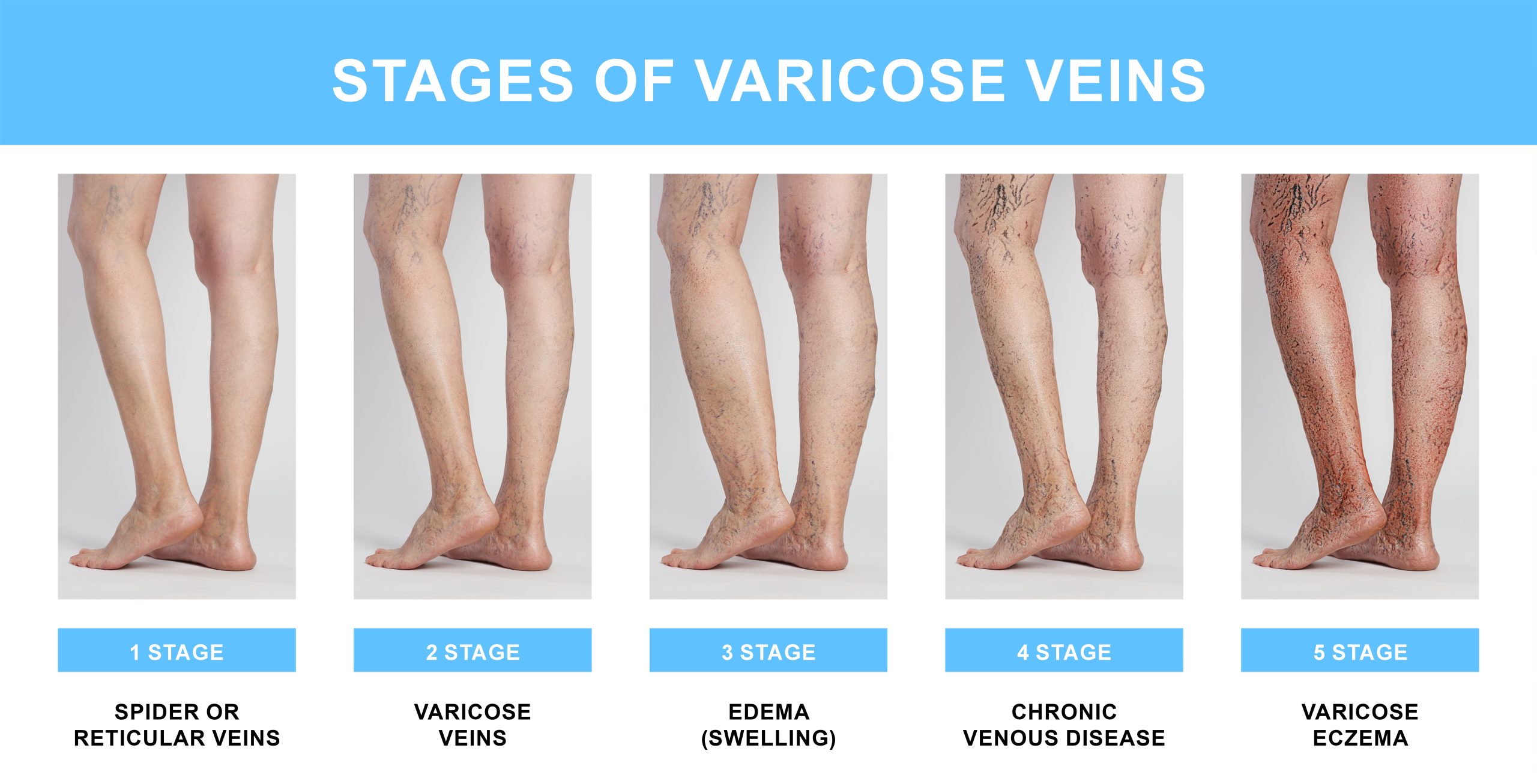 Stages of varicose veins