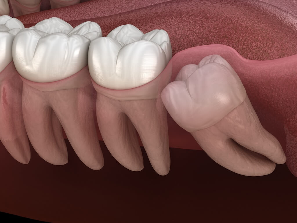 Wisdom teeth extraction consultation