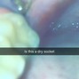 Kdin - Is this a dry socket 