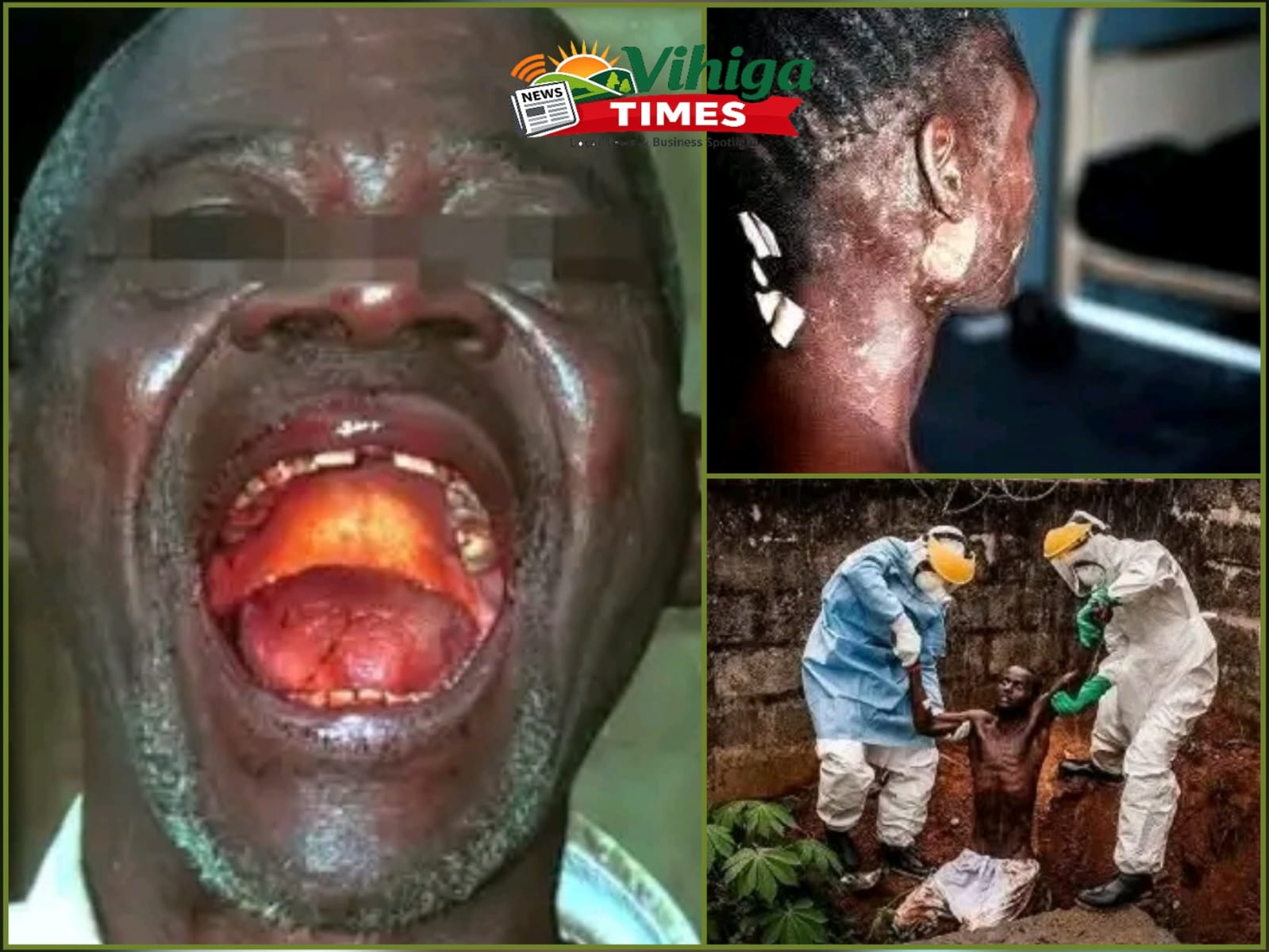 What Vihiga Residents Should Know as Authorities Monitor 2026 Ebola Outbreak