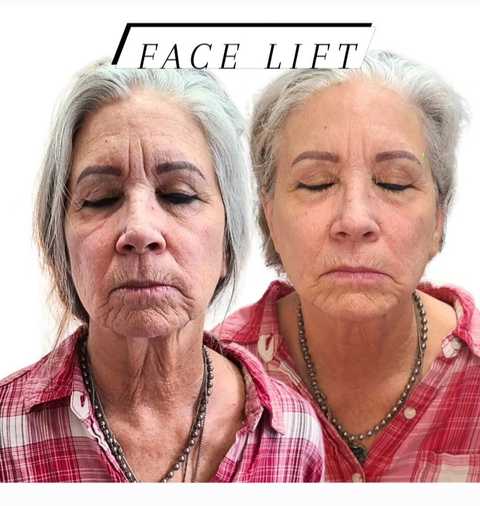 Face Lifting - x4