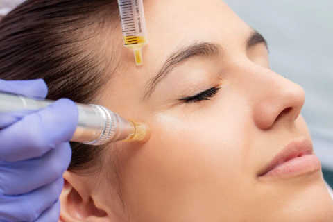 Microneedling (Basic)