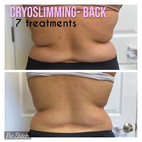 Cryo Slimming