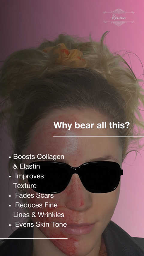 Microneedling ( Special )