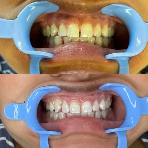 Teeth Whitening service