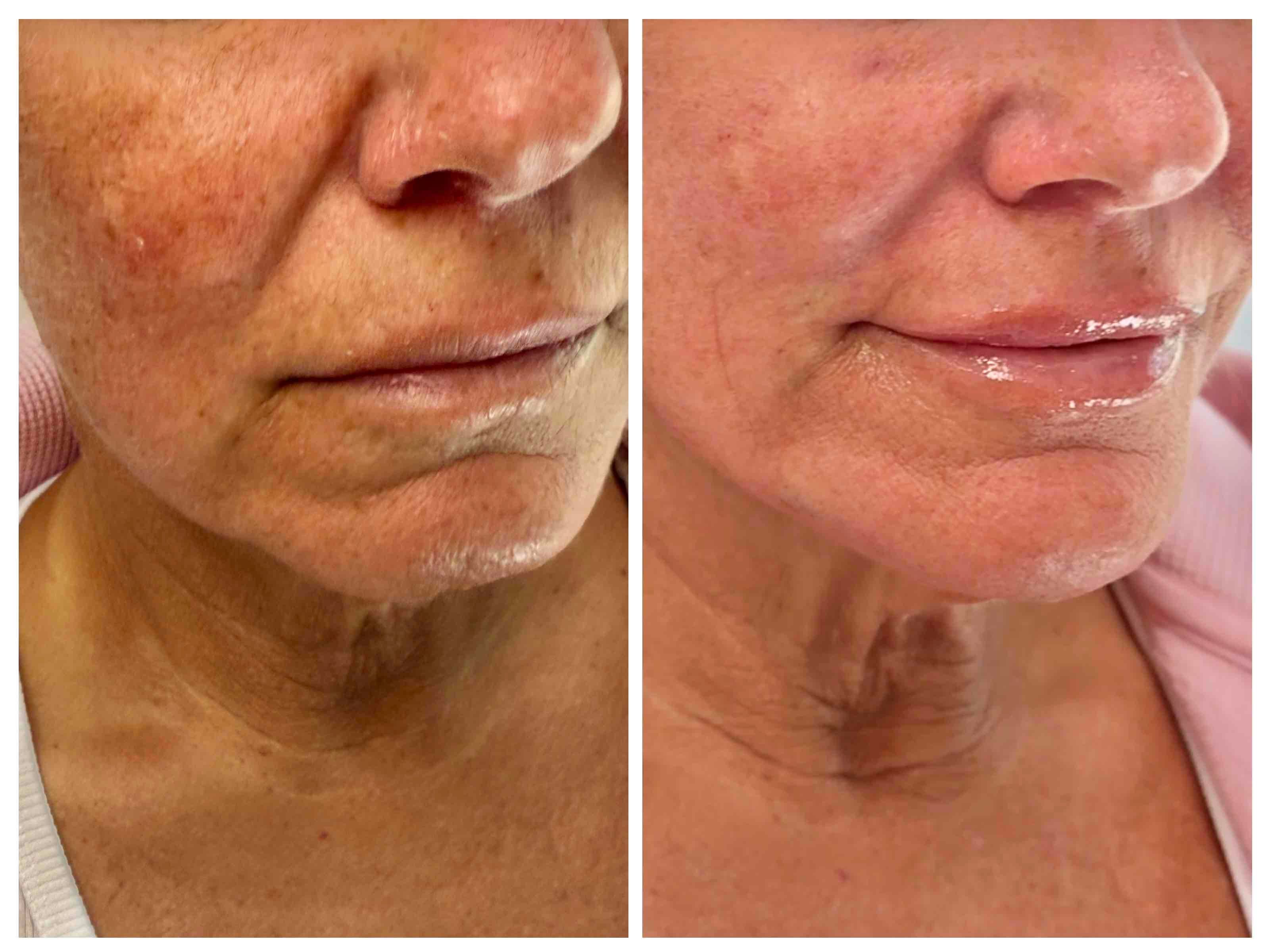  before and after,skin treatment,facial improvement,beauty enhancement 