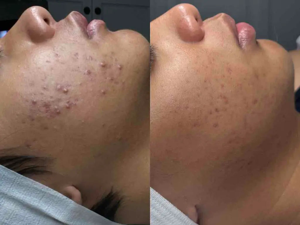 Breakouts, Acne & Congestion