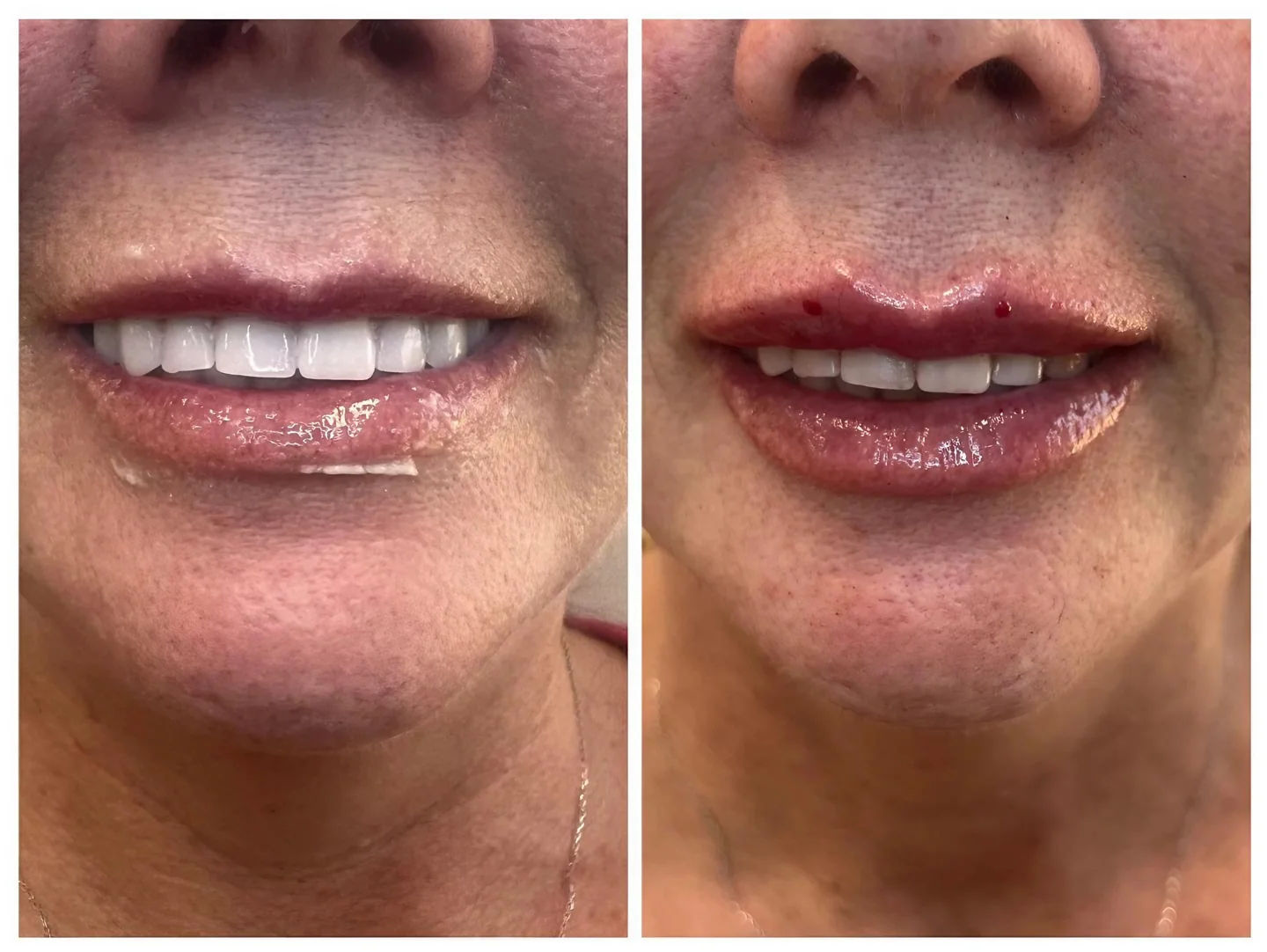  before and after,cosmetic procedure,transformation,lips,beauty  
