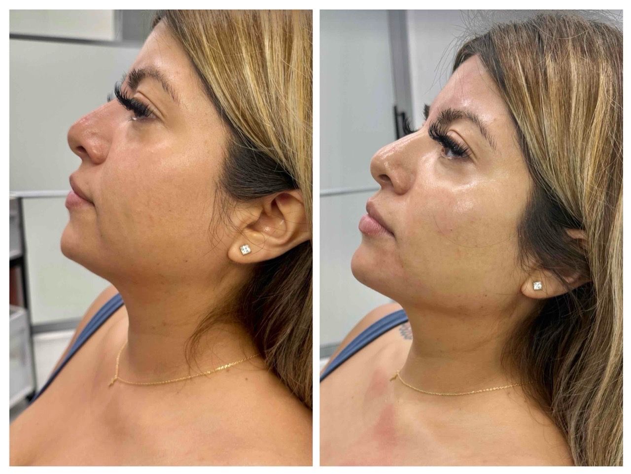 before and after,beauty,transformation,side profile,facial