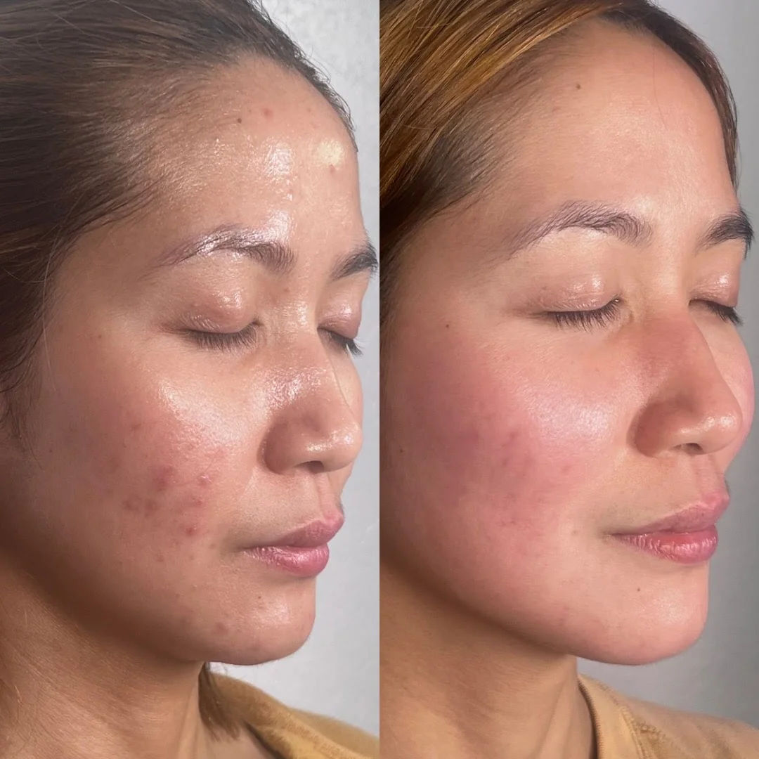  before-after,skin-treatment,facial-care,beauty 