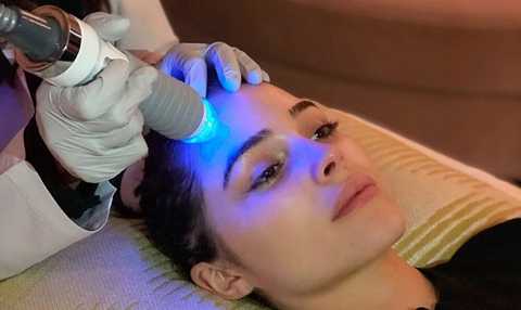 Microneedling service