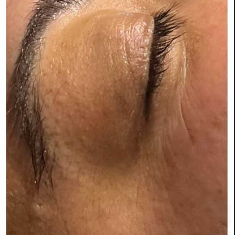 wax for ingrown hairs in Denver City Park West Park Hill