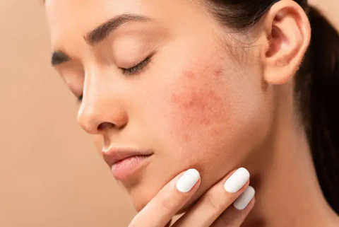 Acne Treatments service