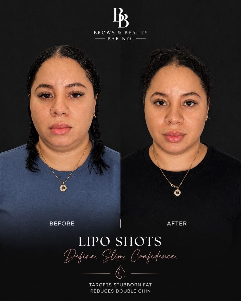  before-after,cosmetic-procedure,portrait,beauty 