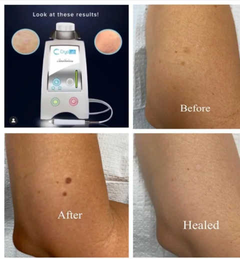 Dark Spot and Skin Tag Removal service