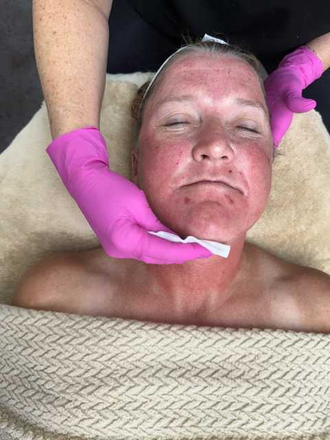 Chemical Peels  40 min service