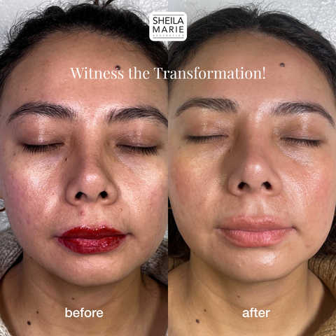 Korean Filler Facial
