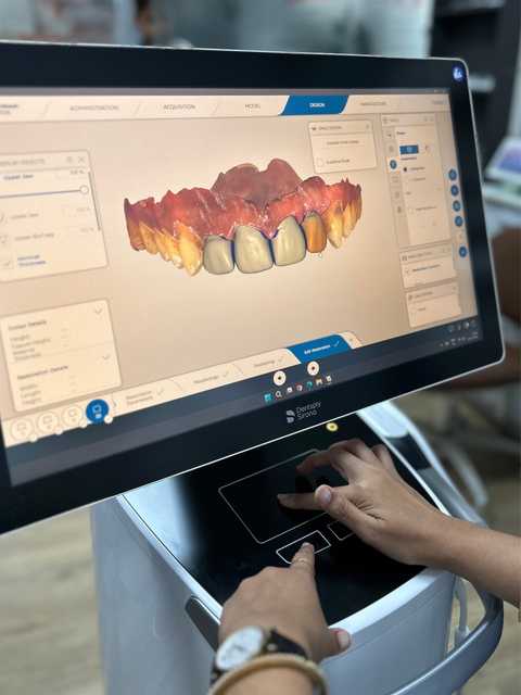 Smile Designing