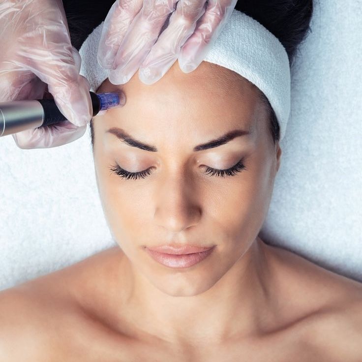 Microneedling