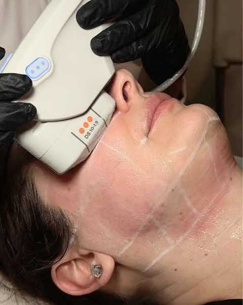 Sagging Jawline? How Ultherapy Prime Lifts Jowls Without Surgery Image