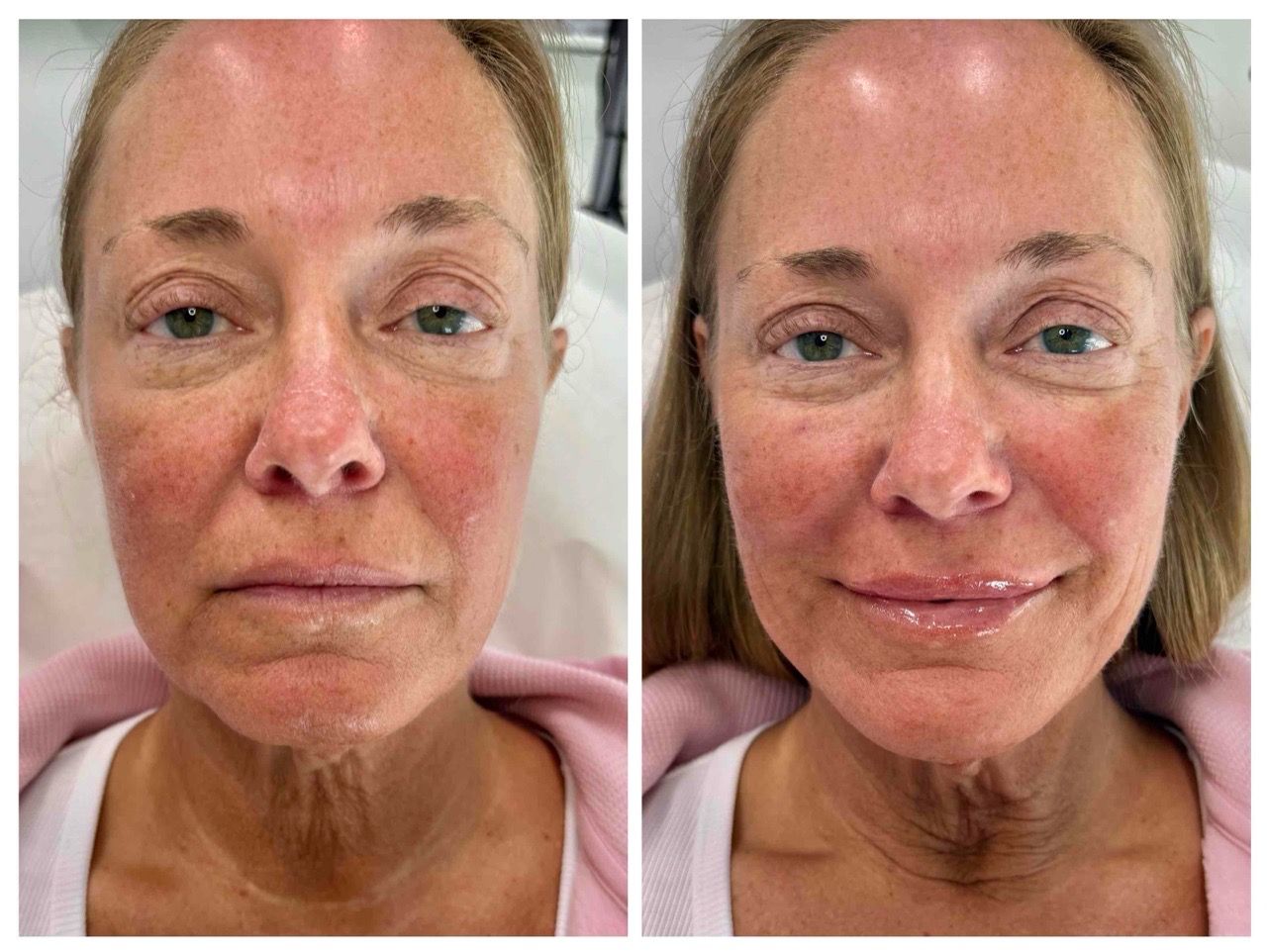  before and after,facial treatment,skincare,beauty transformation  