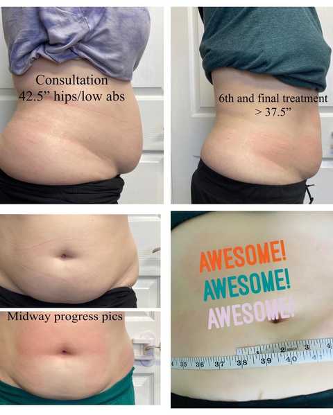 Cryo Slimming
