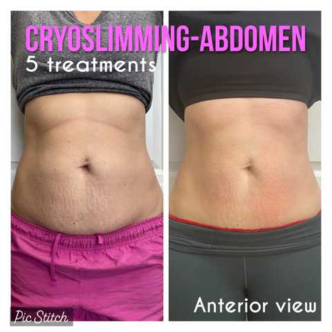 Cryo Slimming
