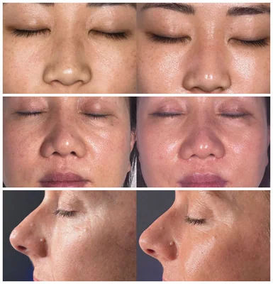 before-after,facial,skincare,treatment