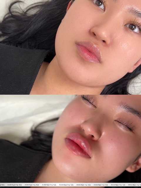 Lip Filler (1ML)