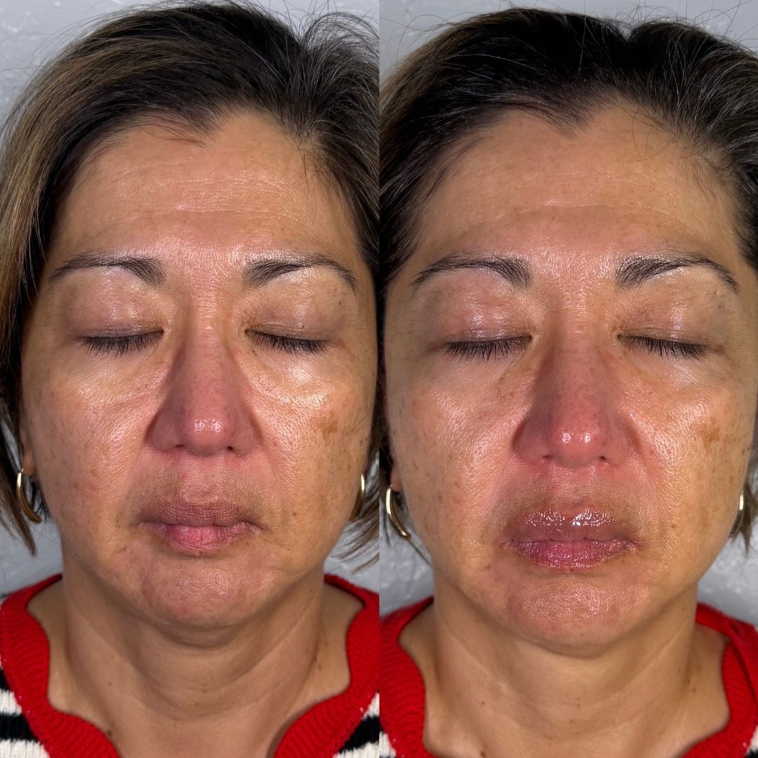  before-after,facial-skin-results,skincare,client-result,complexion,skin-texture,close-up,beauty-treatment 