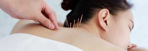 Acupuncture service