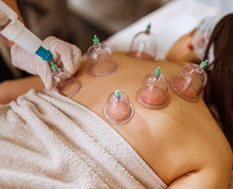 Cupping service