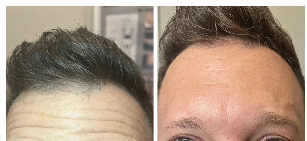  hair,transformation,before and after,hairline  