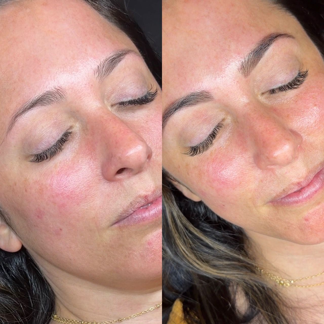  before-and-after,beauty,skin-care,facial 