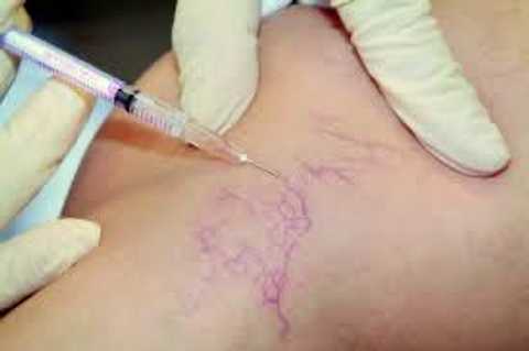 Spider veins removal (Scelrotherapy)