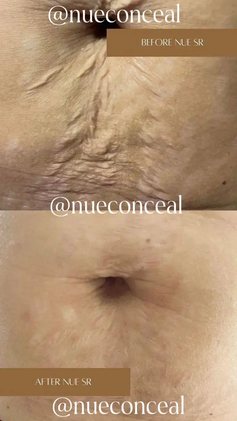 ISR Stretch Mark
