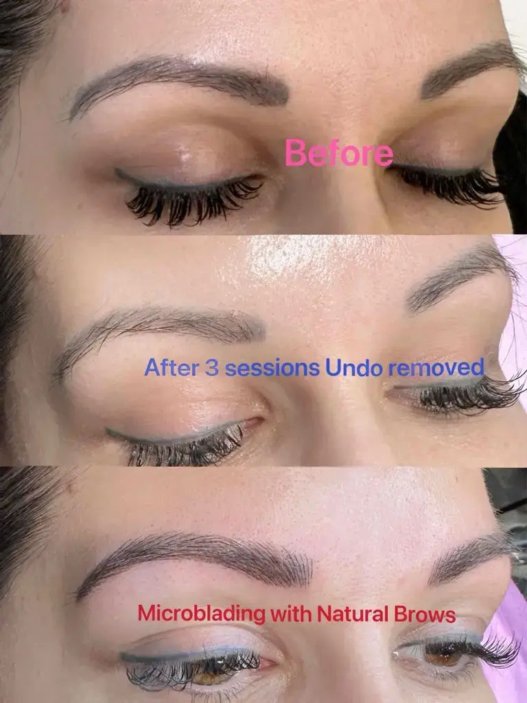 Undo Removal