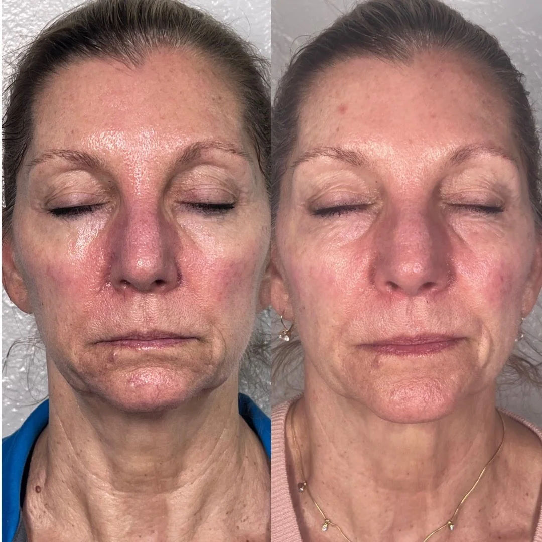  before-and-after,facial-treatment,skincare,transformation  