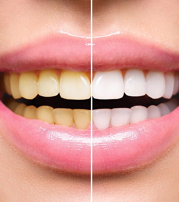 Teeth Cleaning & Whitening