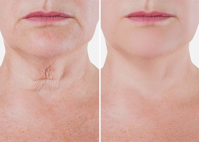 Plasma Skin Resurfacing (Fibroblast Therapy)