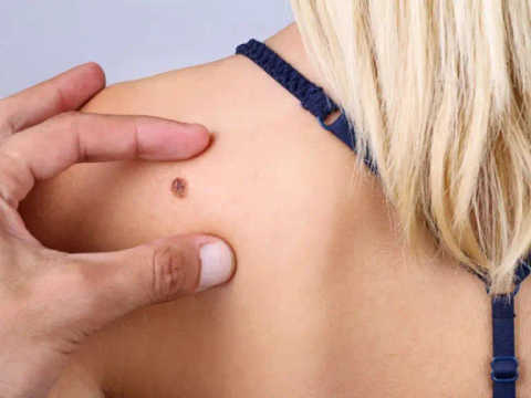 Skin Lesion Removal service