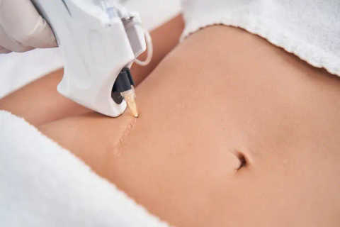 Non-Invasive Scar Treatments service