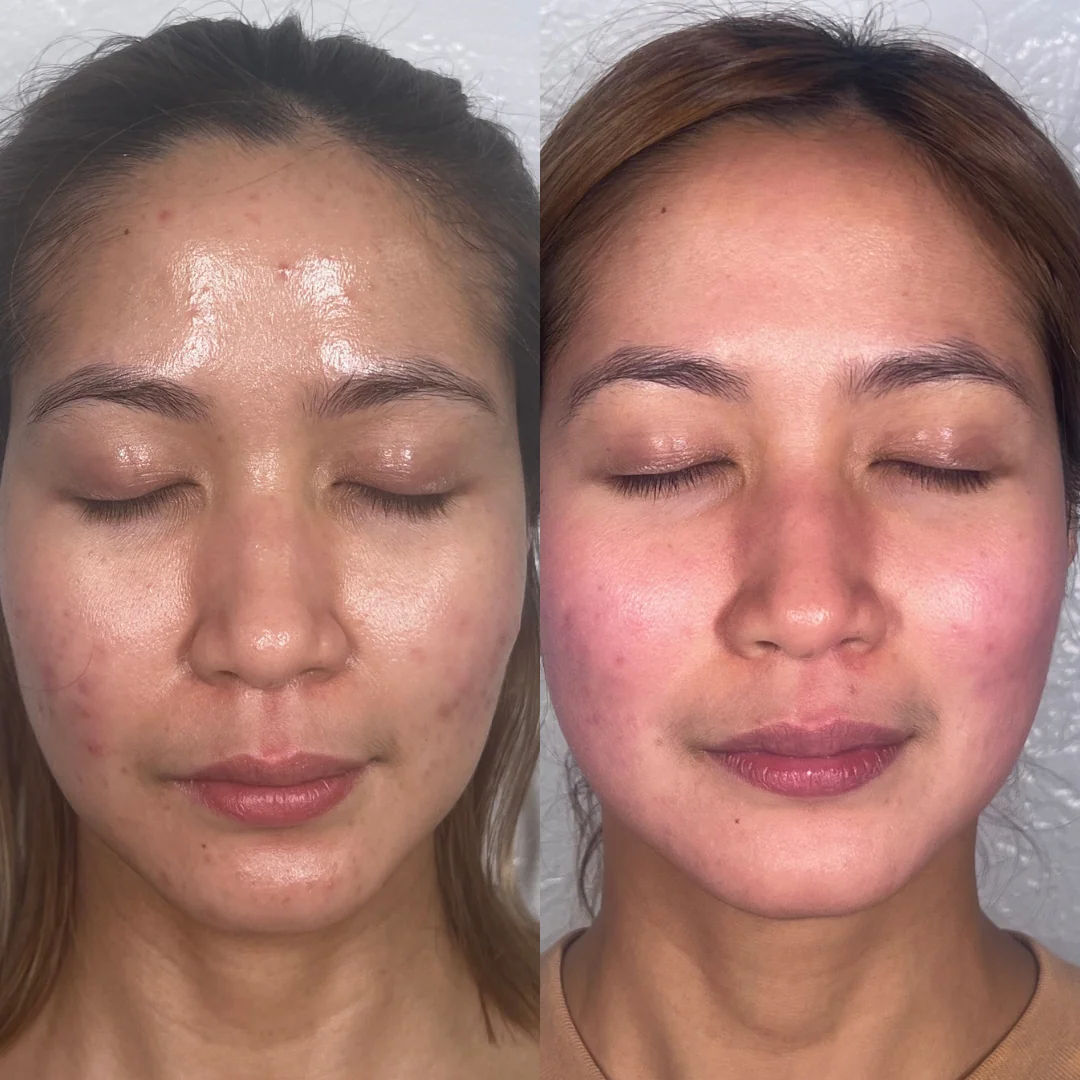  before and after,skin treatment,facial results  