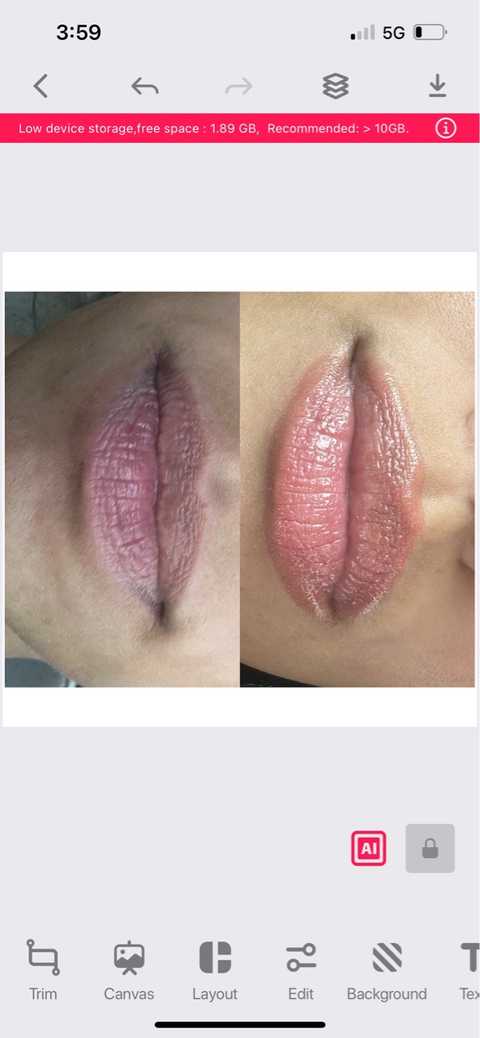 Nano needle lip filler
