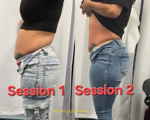 Body Contouring service