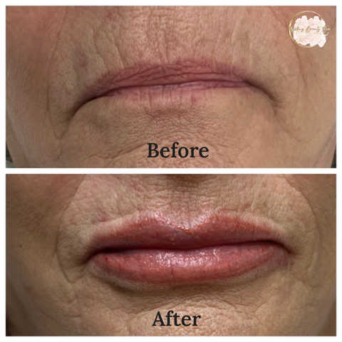 Lip Filler- 1 Syringe Juvederm Ultra XC