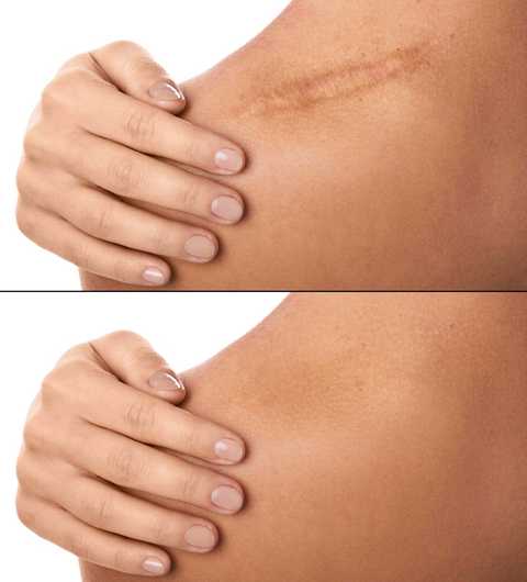 Scars treatments service
