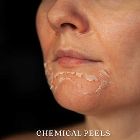 Chemical Peel